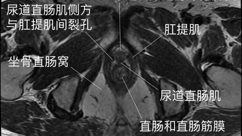 经会阴直肠筋膜前平面入路的建立