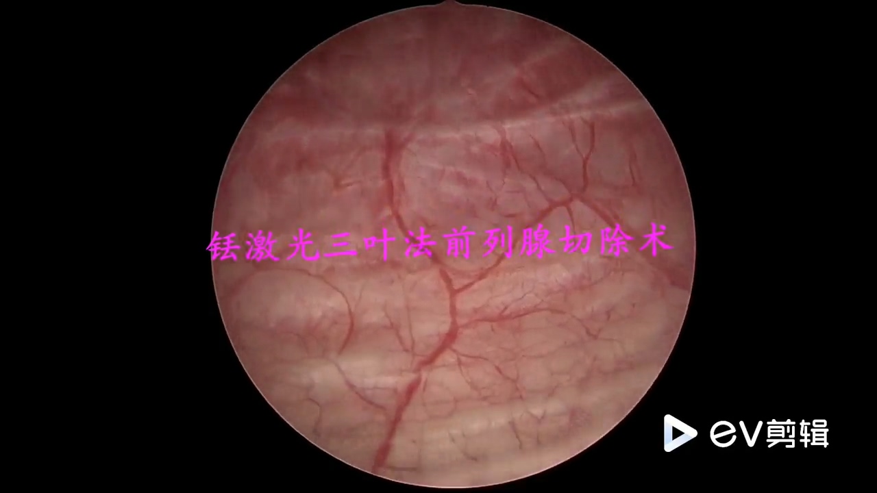 铥激光三叶法前列腺切除术