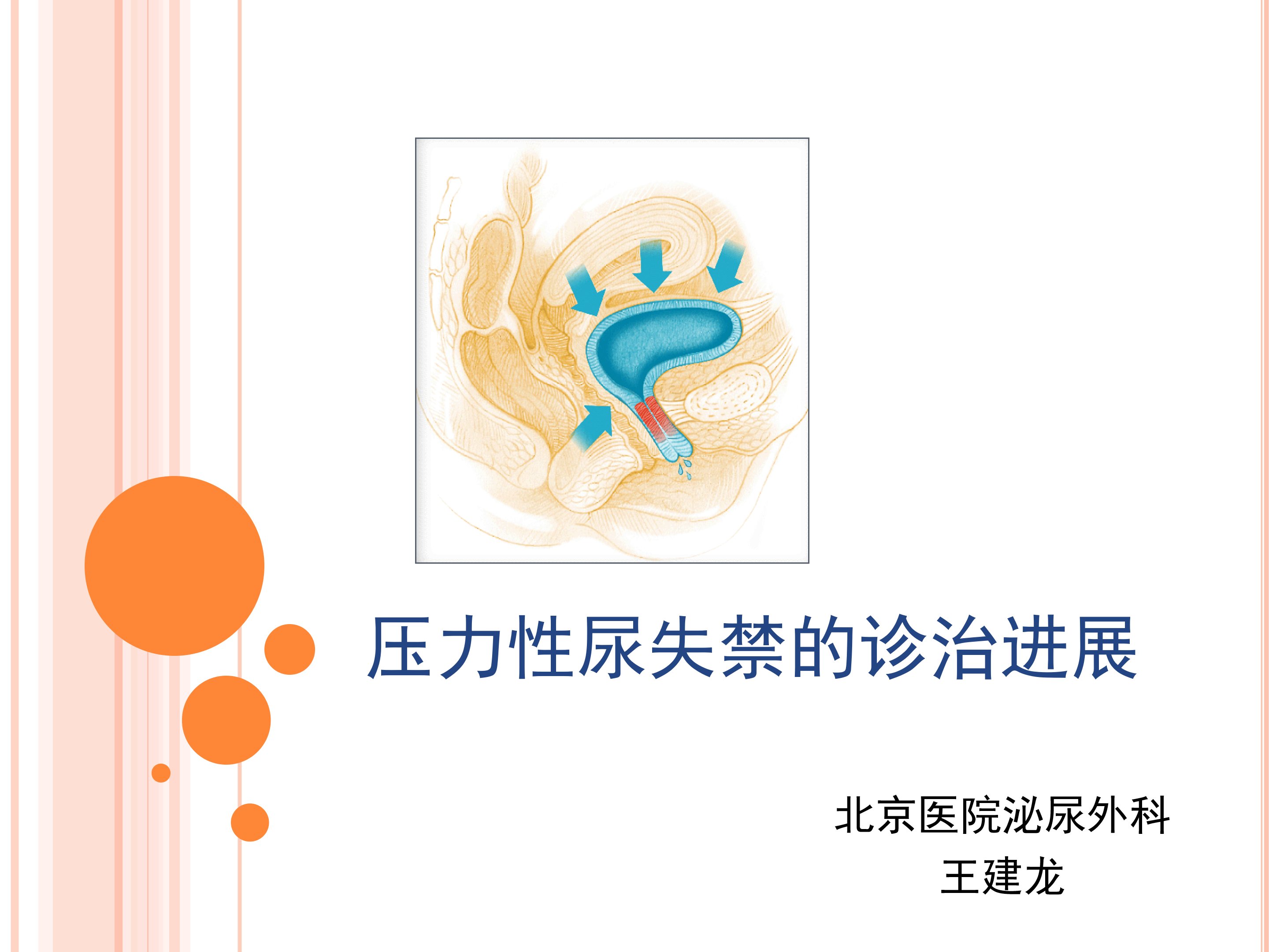 第22期 王建龙 | 压力性尿失禁的诊治进展