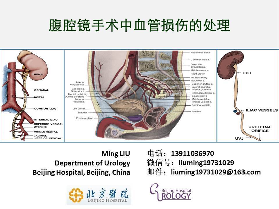 第129期 刘明教授泌尿外科腹腔镜手术中出血的处理