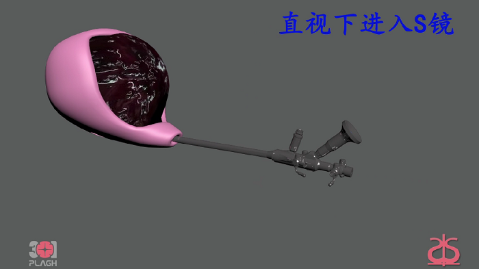 S镜膀胱血块填塞吸除动画