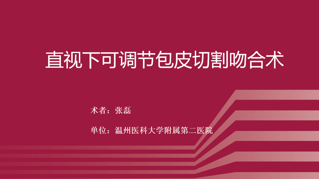直视下可调节包皮切割吻合术