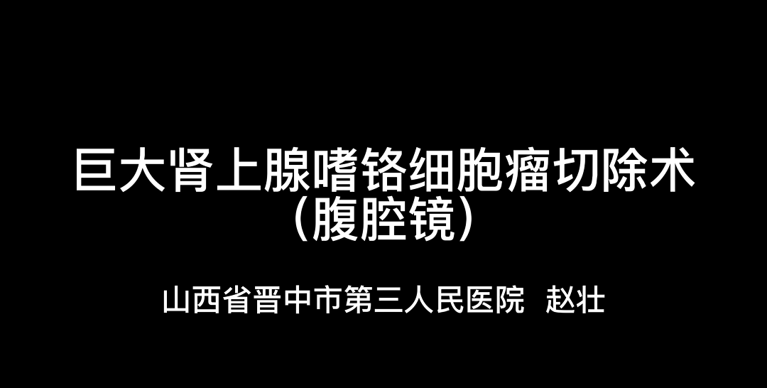 赵壮 | 巨大肾上腺嗜铬细胞瘤切除术（腹腔镜）
