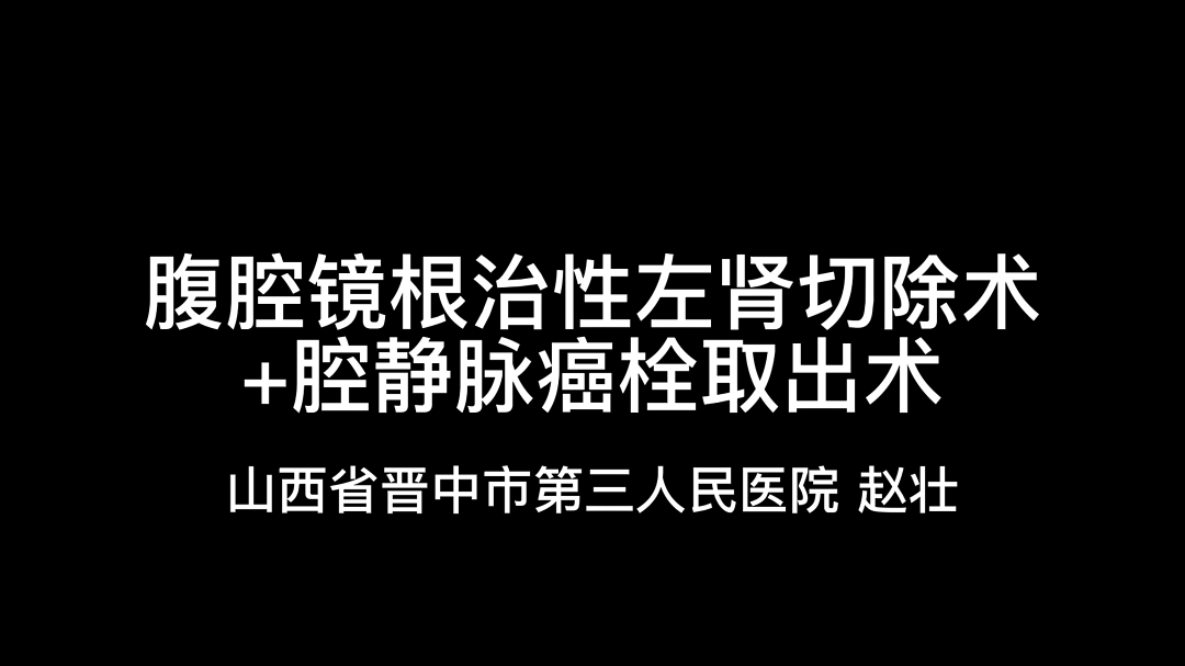 赵壮 | 腹腔镜根治性左肾切除术+腔静脉癌栓取出术