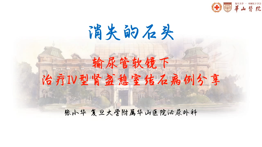 输尿管软镜下治疗IV型肾盏憩室结石（右侧经尿道输尿管软镜下激光碎石术）